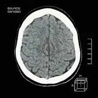 Aphasia